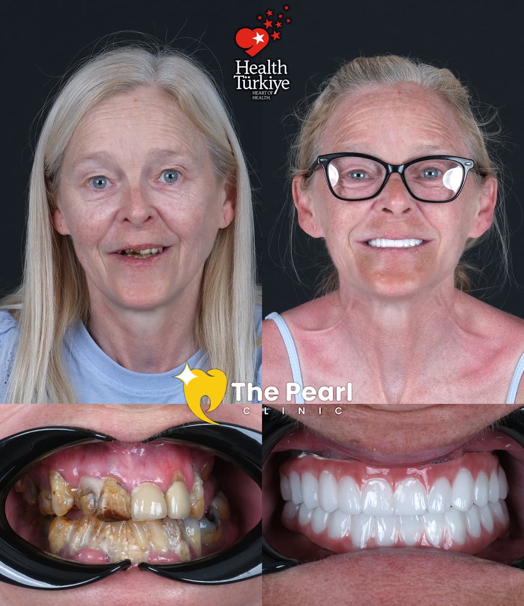 All-on-6 Transformation 1